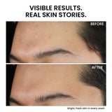 Skinovate Anti-Acne Facewash with 2% Salicylic Acid & Vitamin C – 100ml