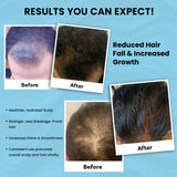 Hair Fall Control & Regrowth Combo