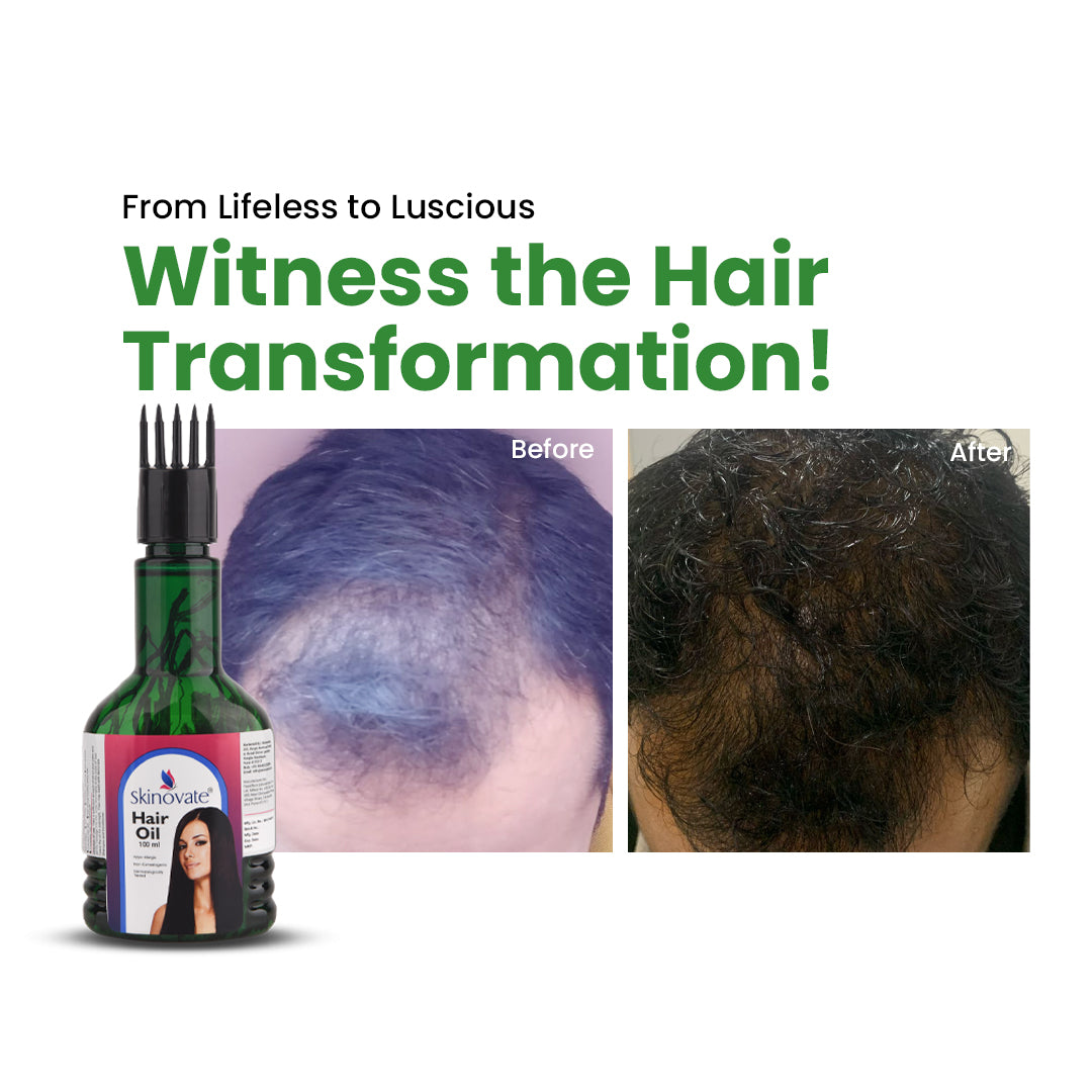Skinovate Hair Oil | Dermatologically Tested | Promotes Hair Growth